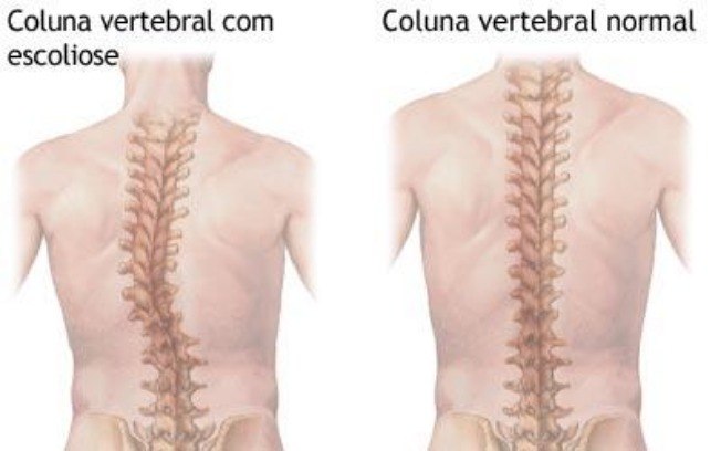 Leia mais sobre o artigo Saiba se você tem escoliose e como tratar a coluna em forma de S