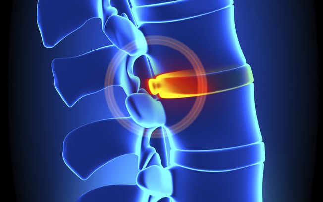 Leia mais sobre o artigo Cirurgia minimamente invasiva da coluna; saiba o que é