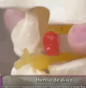 Leia mais sobre o artigo Programa Você Bonita – TV Gazeta. Tema: Hérnia de Disco